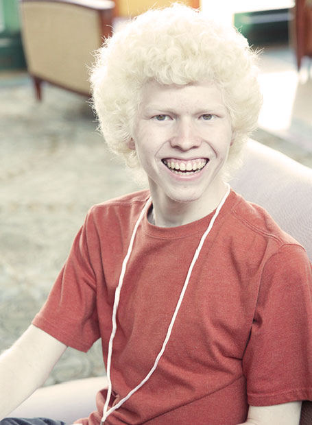 albinism in african americans