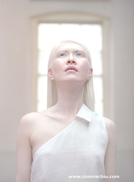 asian people with albinism